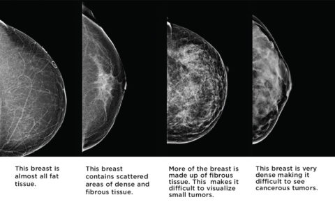 Mammogram Or Ultrasound Or Both? - Dr. Zembroski