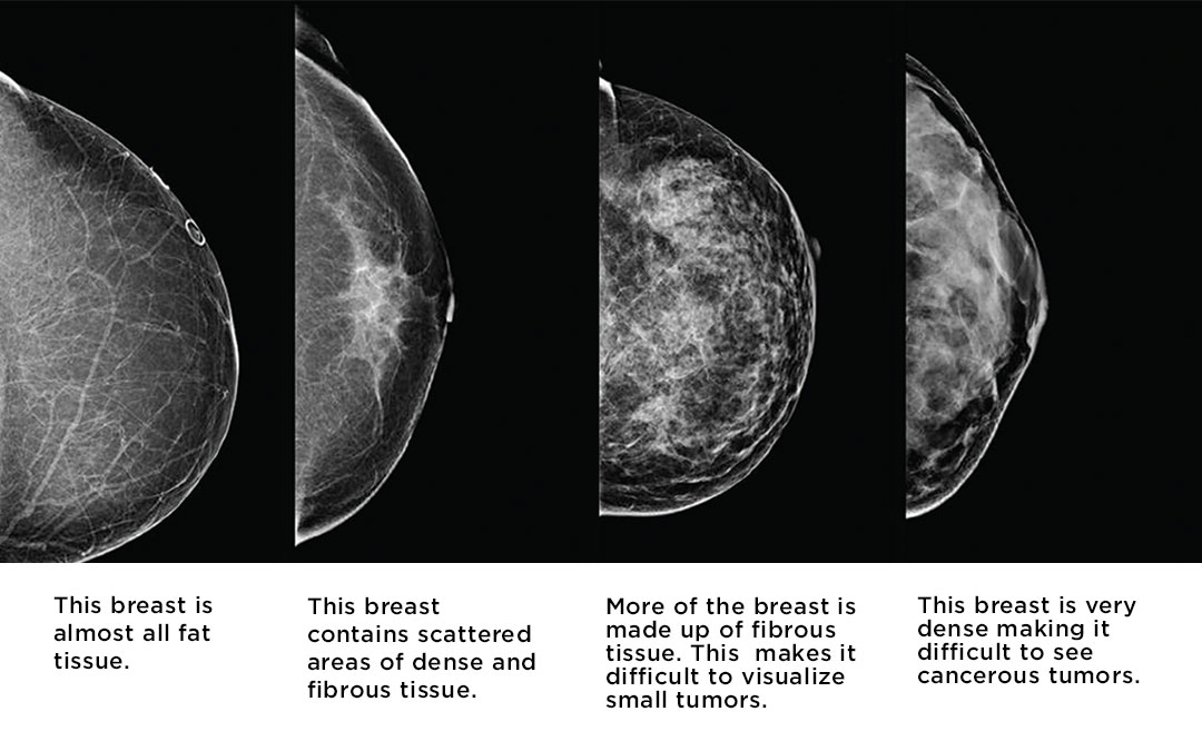 Breast Density 